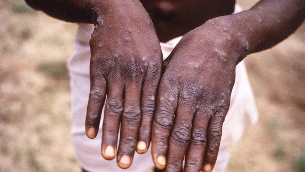 Should We Be Taking Monkeypox as a Serious Public Health Threat in Columbus?